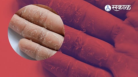 Skin Peeling Of Hand And Feet