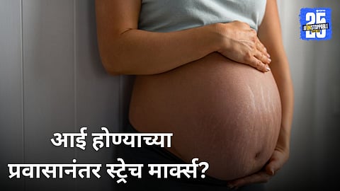 Home Remedies For Stretch Marks