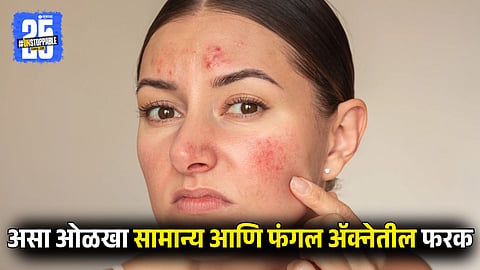 How to Identify Fungal Acne vs Regular Acne
