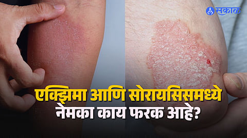 Symptoms of Eczema vs Psoriasis