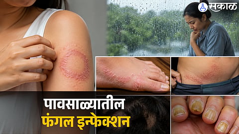 Monsoon Skin Alert: The Ringworm Risk!