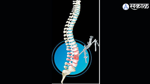 Endoscopic spine surgery offers a minimally invasive option for selected patients with spinal disorders. Experts say proper diagnosis and patient selection are key to achieving the best outcomes.