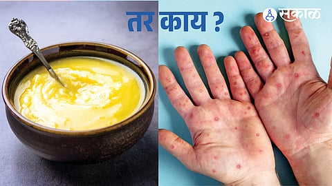 This Ayurveda Q&A explains whether buffalo milk can be used when cow's milk lacks cream for making ghee, and offers Ayurvedic guidance for managing peeling skin and blisters on the palms during summer.