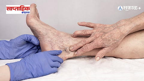 Varicose Veins Symptoms