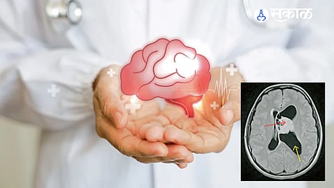 A neurosurgeon recalls a dramatic Ganeshotsav emergency in which timely intervention, police assistance and advanced neurosurgical technology helped save a young brain-tumor patient.