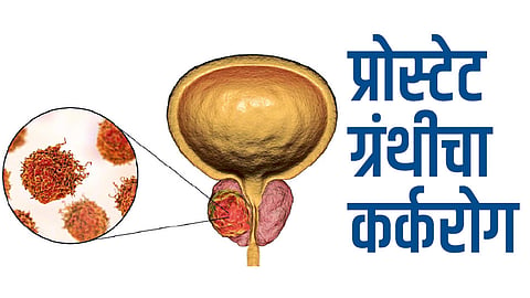 प्रोस्टेट ग्रंथीचा कर्करोग