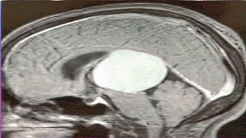 Doctor Found Tennis Ball Size Tumor in womans Brain in Nagpur Latest News