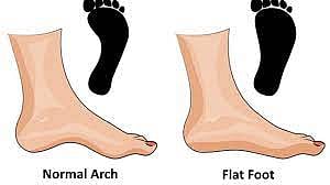 If the legs are flat get treatment immediately Ignoring it will cause damage Nagpur news