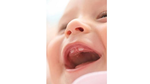 milk-tooth
