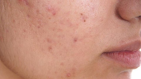 Acne problem