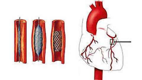 angiography