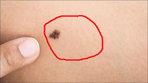 black spot on skin