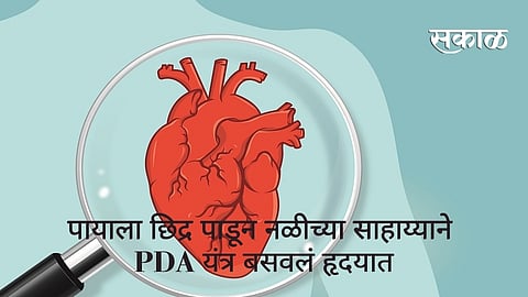 पायाला छिद्र पाडून नळीच्या साहाय्याने PDA यंत्र बसवलं हृदयात; हृदयविकाराच्या दुर्मिळ आजारावर यशस्वी सर्जरी