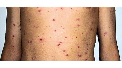 varicella