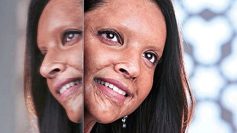 Chhapaak Effect Uttarakhand To Give Pension To Acid Attack Survivors