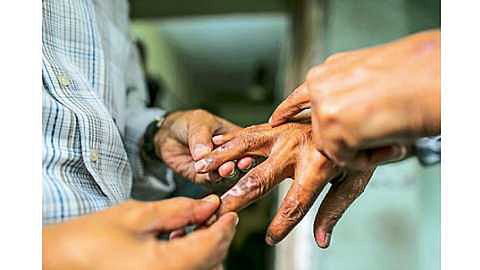 सातारा : कुष्ठरोग व क्षयरोग निर्मूलनासाठी विशेष मोहीम