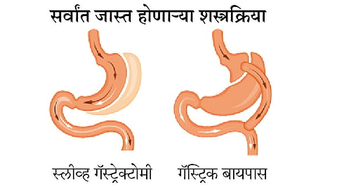 बॅरियाट्रिक शस्त्रक्रिया मधुमेहींसाठी जीवरक्षक