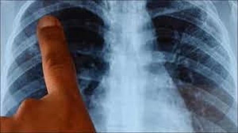 X-Ray