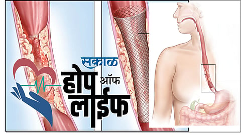 #HopeOfLife : अन्ननलिकेचा कर्करोगही ठरतो जीवघेणा!