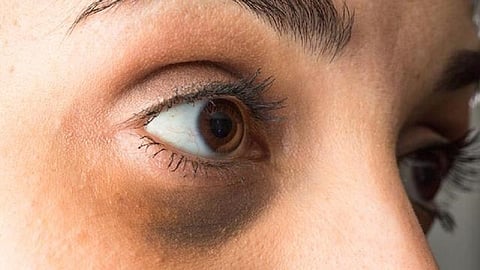 dark circles.jpg
