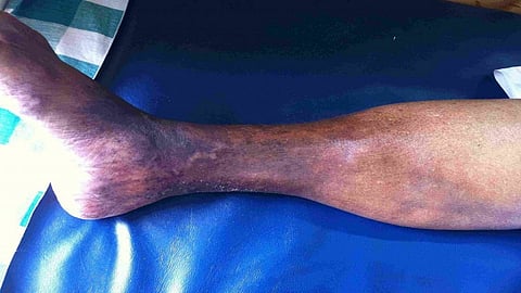 Lipodermatosclerosis