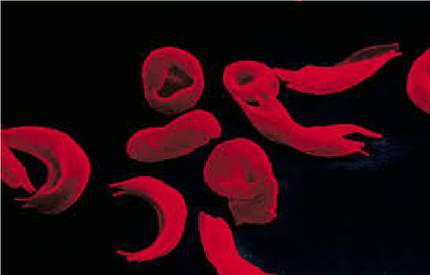 sickle cell center still not ready due to negligence of government in nagpur
