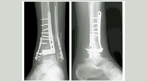 bone