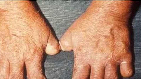 leprosy patients