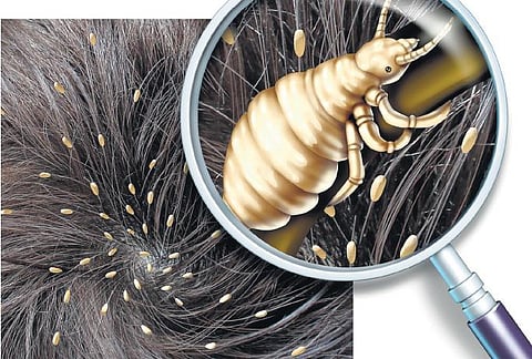 பேனை ஒழிக்க நல்ல மருந்து உண்டா?