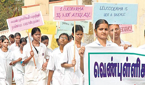 வெண்புள்ளிகளுக்கு முற்றுப்புள்ளி!