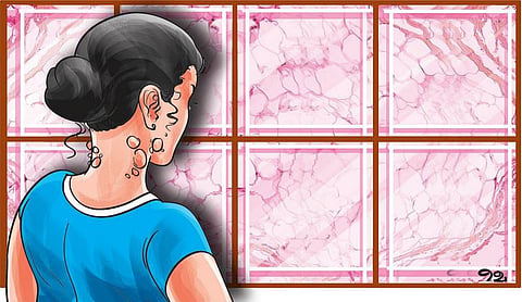 சந்தேகம் சரியா 18: வலி இல்லாத கட்டிகள் புற்றுநோயா?