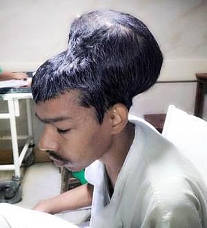 இளைஞரின் மூளையில் 1.8 கிலோ எடையளவில் கட்டி: 6 மணி நேரம் அறுவை சிகிச்சை செய்து அகற்றிய மருத்துவர்கள்