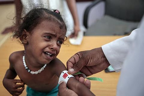 ஏமனில் பசியால் உயிரிழந்த 85,000 குழந்தைகள்
