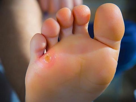 நீரிழிவுப் பாதமும் பாத வழிபாடும்!