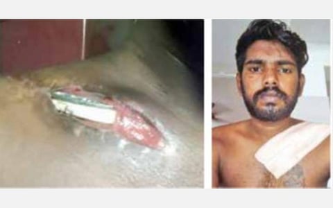 அறுவை சிகிச்சையின்போது தோள் பட்டையில் வைத்து தைக்கப்பட்ட பிளேட் வெளியே தெரிந்ததால் பனியன் தொழிலாளி அதிர்ச்சி