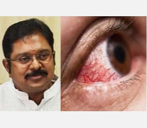 கருப்புப் பூஞ்சை நோயைக் கட்டுப்படுத்த தமிழக அரசு தீவிரமாகச் செயல்பட வேண்டும்: டிடிவி தினகரன் வலியுறுத்தல்