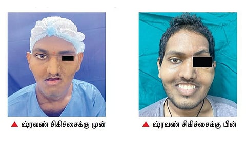 கருப்பு பூஞ்சையால் பாதிக்கப்பட்ட இளைஞருக்கு முகச்சீரமைப்பு: டாக்டர் காமாட்சி நினைவு மருத்துவமனை மறுவாழ்வு