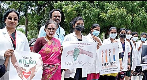 உலக வெண்புள்ளி விழிப்புணர்வு தினத்தை முன்னிட்டு, சென்னை ஓமந்தூரார் அரசு மருத்துவக் கல்லூரி மருத்துவமனையில் டீன் ஜெயந்தி தலைமையில் நேற்று நடைபெற்ற விழிப்புணர்வு மனித சங்கிலியில் மருத்துவ கண்காணிப்பாளர் ஜி.ஆர்.ராஜஸ்ரீ, தோல்நோய் மருத்துவர் ஆதிலட்சுமி, ஒருங்கிணைப்பு அலுவலர் ரமேஷ் மற்றும் மருத்துவர்கள், செவிலியர்கள், பணியாளர்கள் பங்கேற்றனர்.