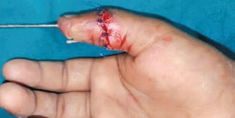 மின் மோட்டாரில் சிக்கி குழந்தையின் கை விரல் துண்டிப்பு - மீண்டும் பொருத்தி பொள்ளாச்சி அரசு மருத்துவமனை சாதனை