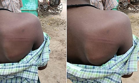 உசிலம்பட்டி அருகே அரசு பள்ளி ஆசிரியை பிரம்பால் அடித்ததில் மாணவர்கள் காயம்