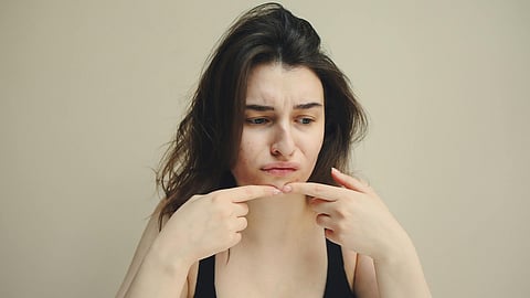 What are electric acne patches and do they actually work?
