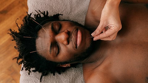 Facial acupuncture: Here’s what you need to know about this celebrity-approved treatment