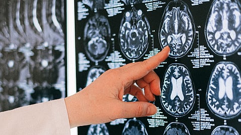 Cerebral malaria