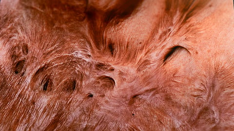 Visual Artist Monica Dhaka turns acid scars into art