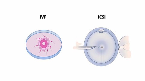 ICSI Fertility Treatment