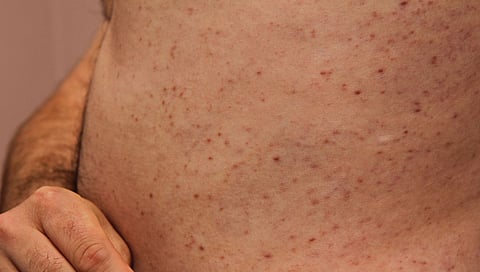mastocytosis