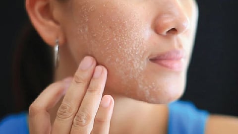 Dry skin