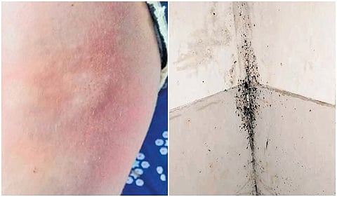 A person at the PMSSY Block shows the rash caused due to the bugs