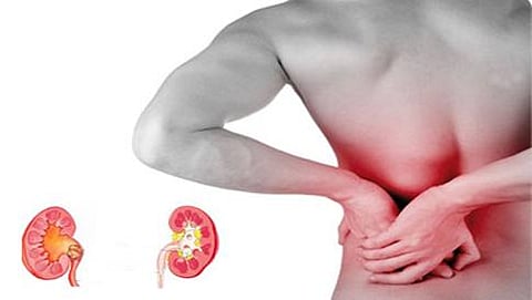 Kidney Stones
