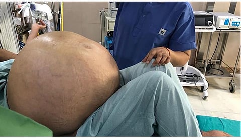 Football sized tumour removed